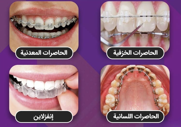إنفزلاين أم تقويم الأسنان العادي: ما هو الأفضل بالنسبة لي 2 إنفزلاين أم تقويم الأسنان العادي: ما هو الأفضل بالنسبة لي 2