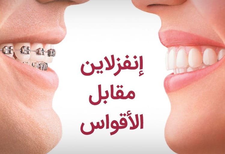 إنفزلاين أم تقويم الأسنان العادي: ما هو الأفضل بالنسبة لي 1 إنفزلاين أم تقويم الأسنان العادي: ما هو الأفضل بالنسبة لي 1