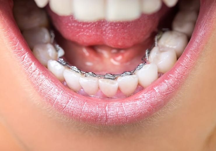 إنفزلاين أم تقويم الأسنان العادي: ما هو الأفضل بالنسبة لي 5 إنفزلاين أم تقويم الأسنان العادي: ما هو الأفضل بالنسبة لي 5