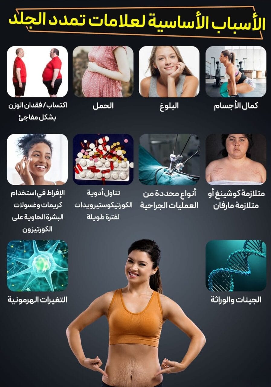كيف أتخلص من علامات تمدد الجلد؟ 3 كيف أتخلص من علامات تمدد الجلد؟ 3