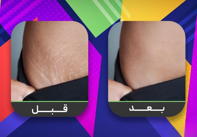 كيف أتخلص من علامات تمدد الجلد؟ 5 كيف أتخلص من علامات تمدد الجلد؟ 5