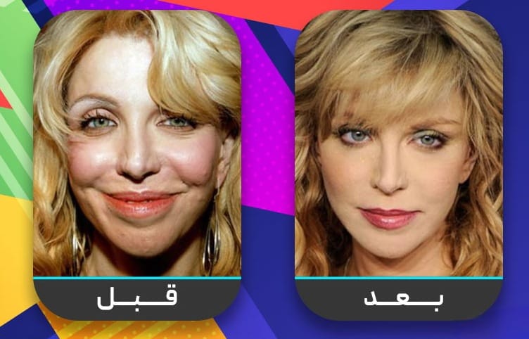 عشرون شخصية مشهورة اعترفت بإجراء عملية تجميل الأنف 14 عشرون شخصية مشهورة اعترفت بإجراء عملية تجميل الأنف 14