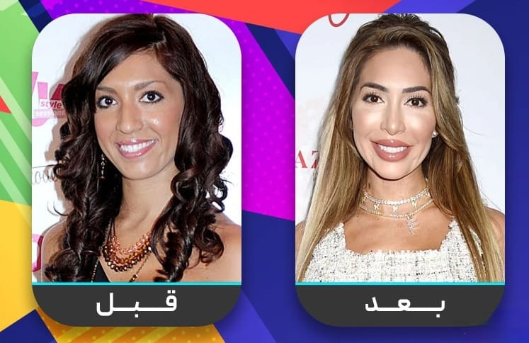 عشرون شخصية مشهورة اعترفت بإجراء عملية تجميل الأنف 20 عشرون شخصية مشهورة اعترفت بإجراء عملية تجميل الأنف 20