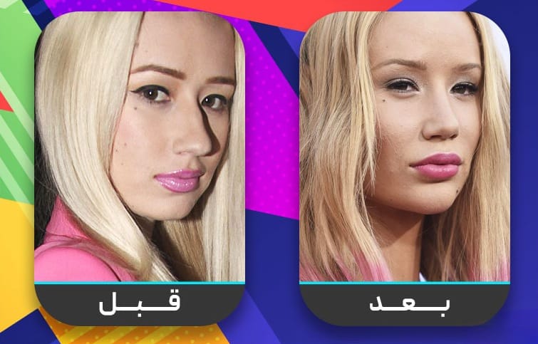 عشرون شخصية مشهورة اعترفت بإجراء عملية تجميل الأنف 13 عشرون شخصية مشهورة اعترفت بإجراء عملية تجميل الأنف 13