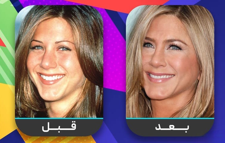 عشرون شخصية مشهورة اعترفت بإجراء عملية تجميل الأنف 2 عشرون شخصية مشهورة اعترفت بإجراء عملية تجميل الأنف 2