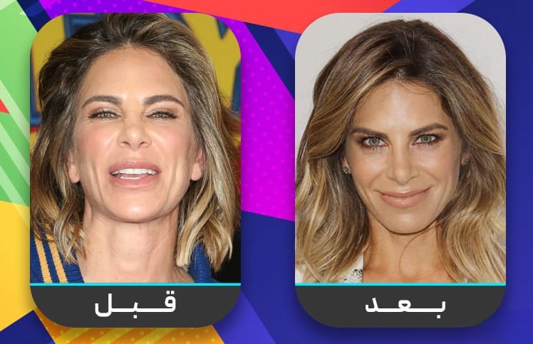 عشرون شخصية مشهورة اعترفت بإجراء عملية تجميل الأنف 9 عشرون شخصية مشهورة اعترفت بإجراء عملية تجميل الأنف 9