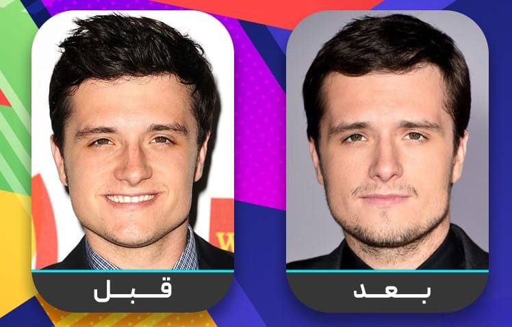 عشرون شخصية مشهورة اعترفت بإجراء عملية تجميل الأنف 21 عشرون شخصية مشهورة اعترفت بإجراء عملية تجميل الأنف 21