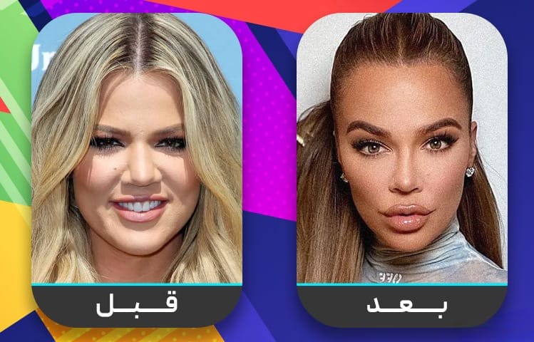 عشرون شخصية مشهورة اعترفت بإجراء عملية تجميل الأنف 7 عشرون شخصية مشهورة اعترفت بإجراء عملية تجميل الأنف 7