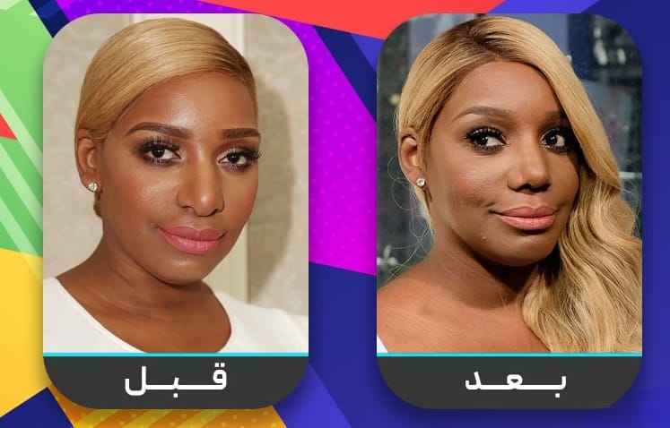 عشرون شخصية مشهورة اعترفت بإجراء عملية تجميل الأنف 17 عشرون شخصية مشهورة اعترفت بإجراء عملية تجميل الأنف 17