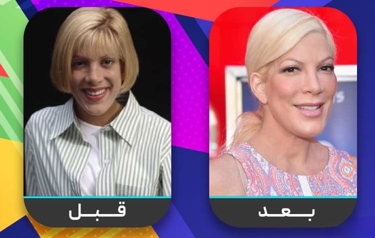 عشرون شخصية مشهورة اعترفت بإجراء عملية تجميل الأنف 16 عشرون شخصية مشهورة اعترفت بإجراء عملية تجميل الأنف 16