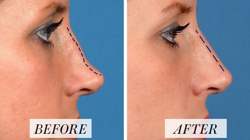 تجميل الأنف بدون جراحة – حقيقة أم خرافة؟ 3 تجميل الأنف بدون جراحة – حقيقة أم خرافة؟ 3