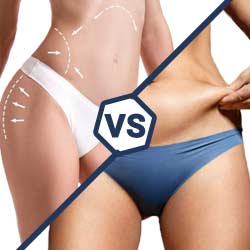 نحت الدهون أم شفط الدهون: أيهما الأفضل؟