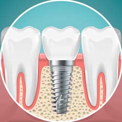 دليل التعافي بعد زراعة الأسنان: تعليمات ما بعد العملية
