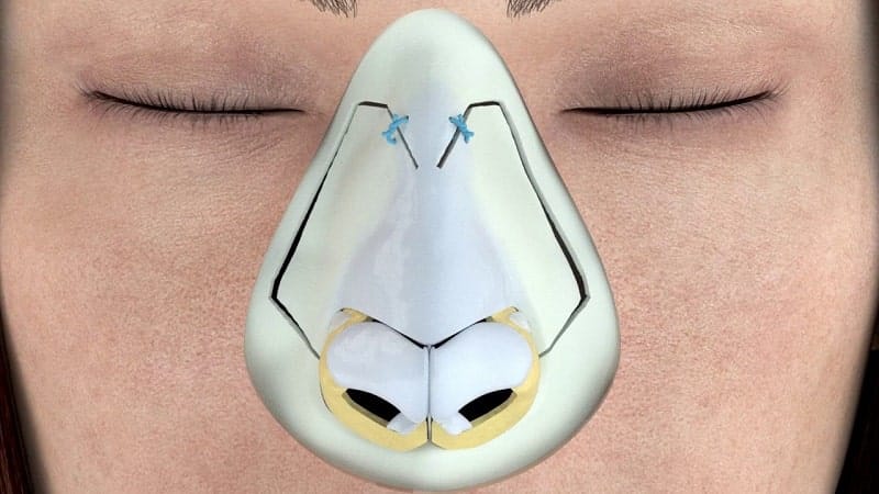 تجميل الأنف بدون جراحة – حقيقة أم خرافة؟ 4 تجميل الأنف بدون جراحة – حقيقة أم خرافة؟ 4