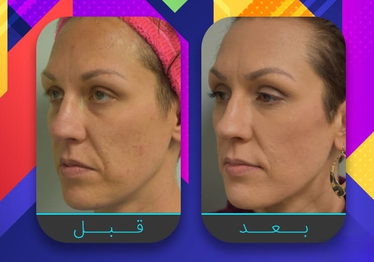 سبعة إجراءات غير جراحية لبشرة مشدودة أكثر 4 سبعة إجراءات غير جراحية لبشرة مشدودة أكثر 4