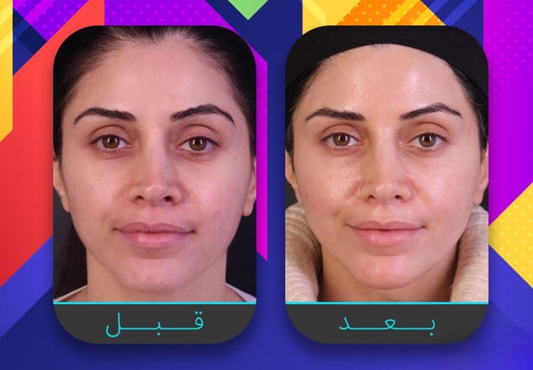 سبعة إجراءات غير جراحية لبشرة مشدودة أكثر 2 سبعة إجراءات غير جراحية لبشرة مشدودة أكثر 2
