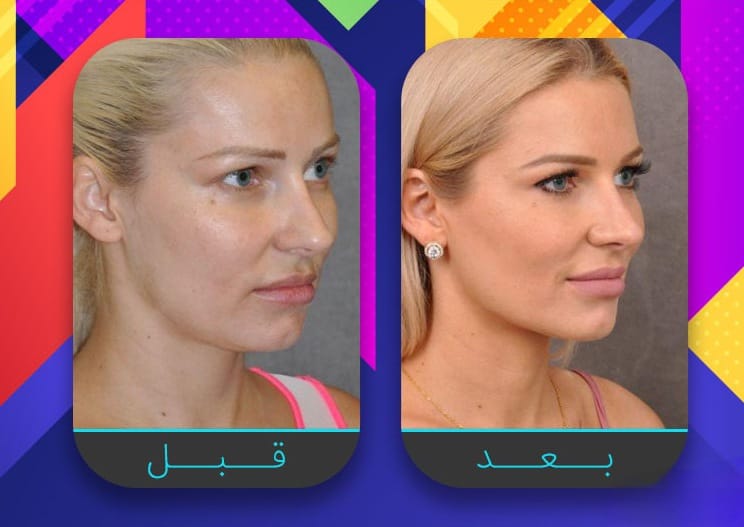 سبعة إجراءات غير جراحية لبشرة مشدودة أكثر 5 سبعة إجراءات غير جراحية لبشرة مشدودة أكثر 5