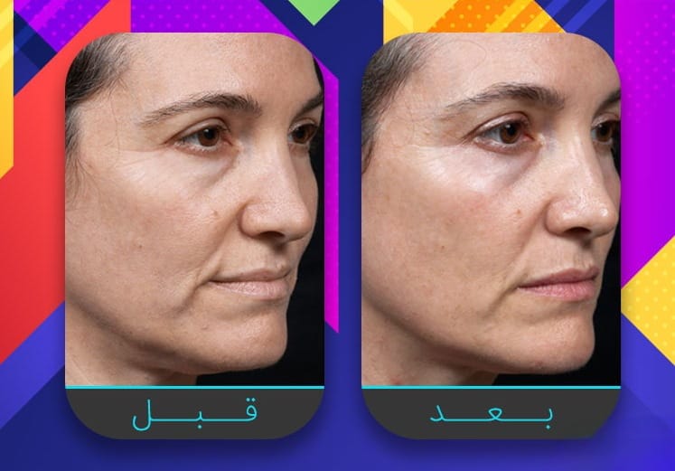 سبعة إجراءات غير جراحية لبشرة مشدودة أكثر 3 سبعة إجراءات غير جراحية لبشرة مشدودة أكثر 3