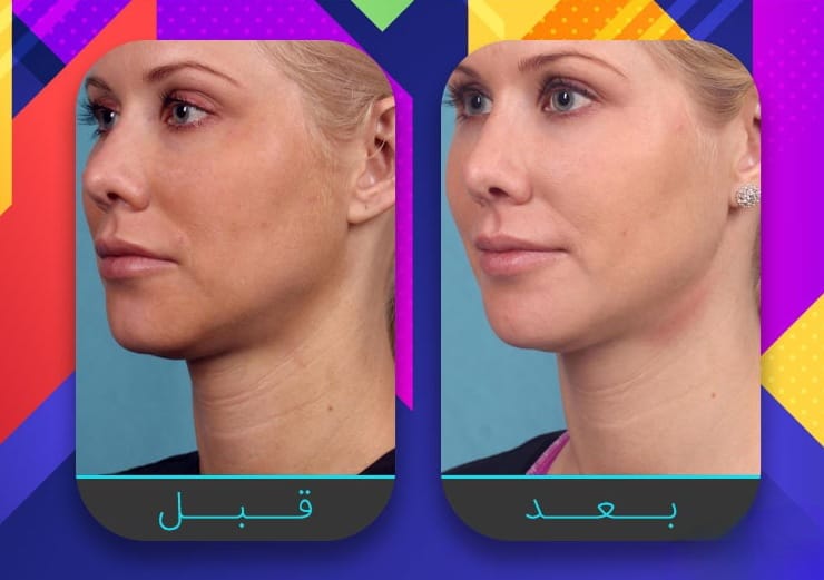 سبعة إجراءات غير جراحية لبشرة مشدودة أكثر 7 سبعة إجراءات غير جراحية لبشرة مشدودة أكثر 7