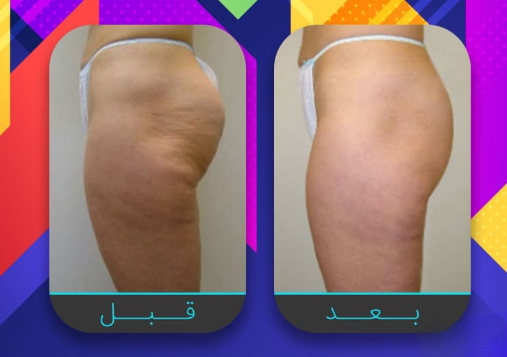 سبعة إجراءات غير جراحية لبشرة مشدودة أكثر 8 سبعة إجراءات غير جراحية لبشرة مشدودة أكثر 8