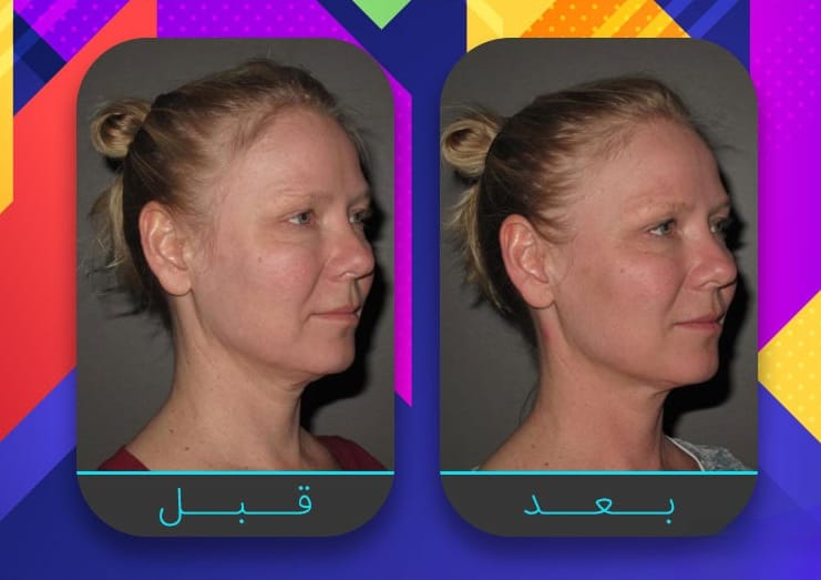 سبعة إجراءات غير جراحية لبشرة مشدودة أكثر 6 سبعة إجراءات غير جراحية لبشرة مشدودة أكثر 6