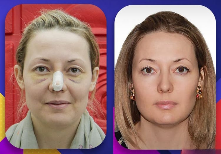 الكدمات بعد عملية تجميل الانف 4 الكدمات بعد عملية تجميل الانف 4