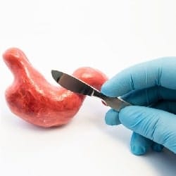 أهم 7 أشياء يجب أن تعرفها عن عملية تكميم المعدة 6 أهم 7 أشياء يجب أن تعرفها عن عملية تكميم المعدة