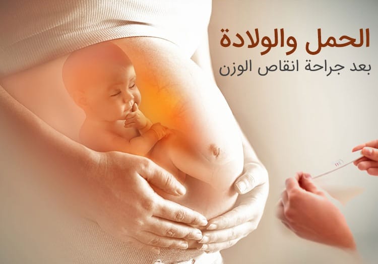 الحمل بعد عملية انقاص الوزن 1 الحمل بعد عملية انقاص الوزن 1