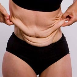 الجلد الزائد بعد عملية إنقاص الوزن: لماذا يحدث وكيف يتم التعامل معه؟ 4 الجلد الزائد بعد عملية إنقاص الوزن: لماذا يحدث وكيف يتم التعامل معه؟