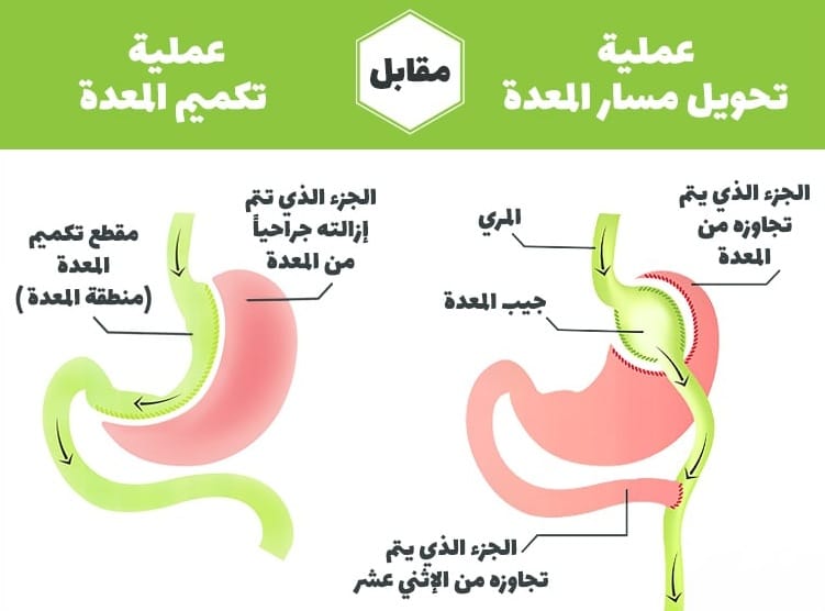 تحويل مسار المعدة وتكميم المعدة: بماذا يختلفان؟ 1 تحويل مسار المعدة وتكميم المعدة: بماذا يختلفان؟ 1