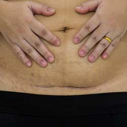 كيف أقلل ندبات عملية انقاص الوزن؟ 2 كيف أقلل ندبات عملية انقاص الوزن؟